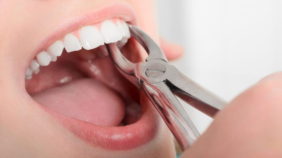 Oral Surgery (Tooth Extraction)