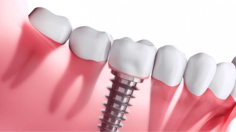 Dental Implants