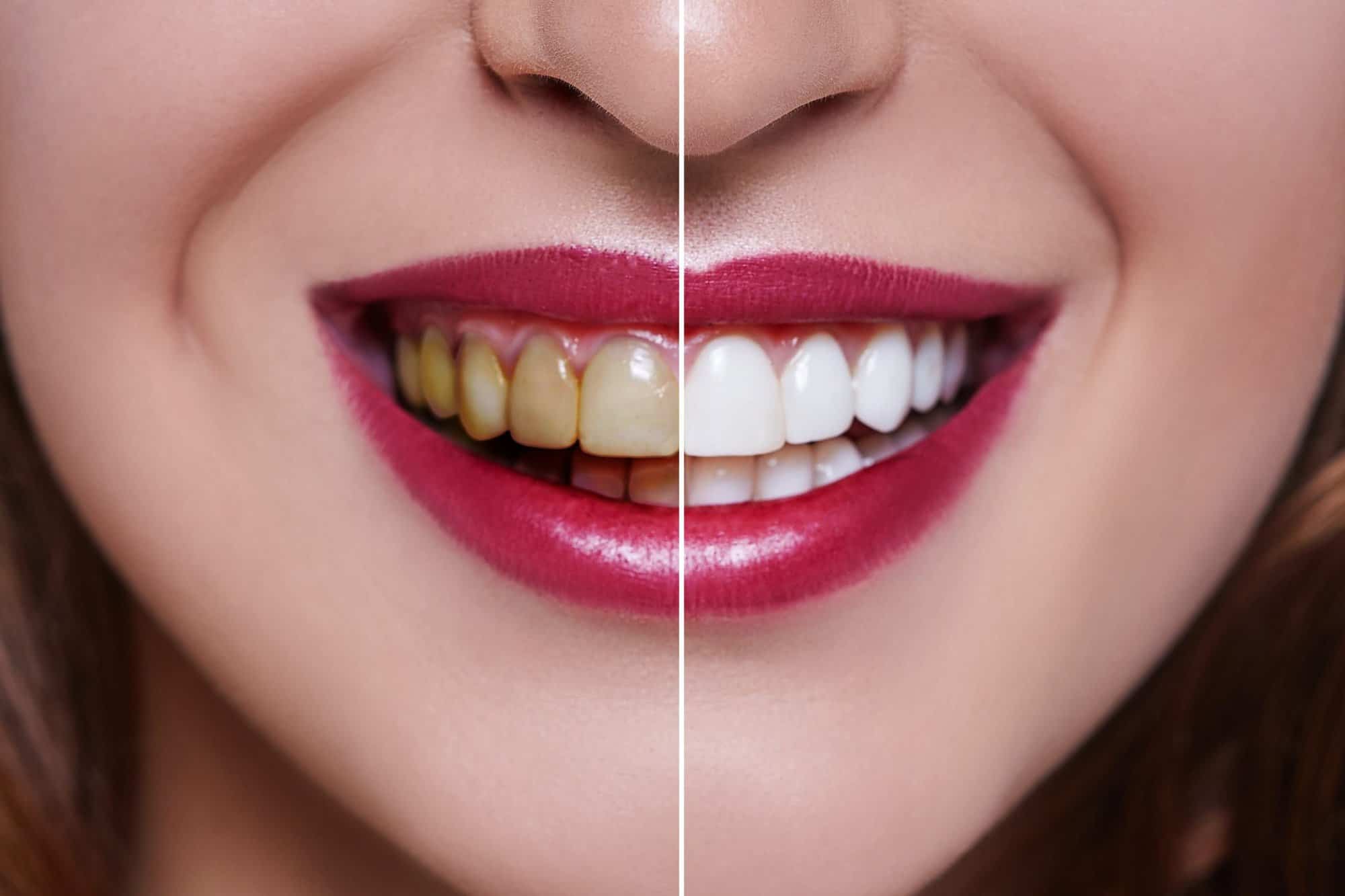 Teeth Whitening/Bleaching